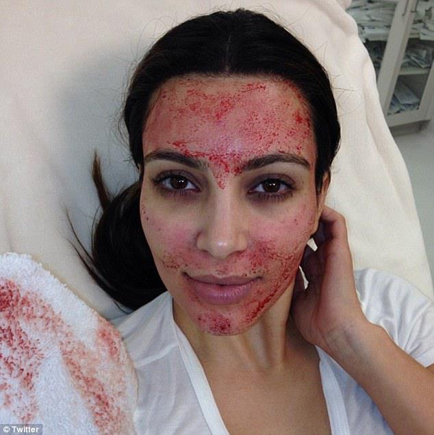 Kim Kardashian Vampire Facial Bloody Face Blood Facial